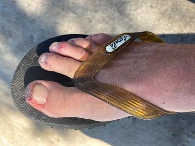 MAUI OWIE: Island Leads Nation in Serious Toe-Stub Injuries
